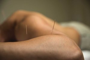 Acupuncture treatment in West London W6 Hammersmith clinic